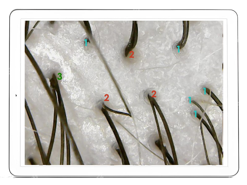 Hair Medica AI - Gęstość włosów