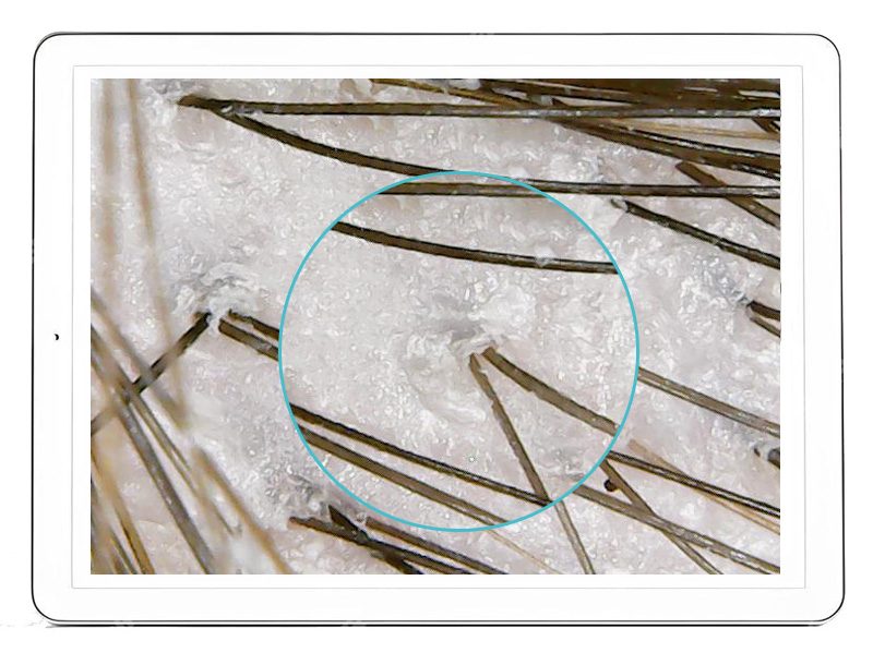 Hair Medica AI - Stan ujść mieszków