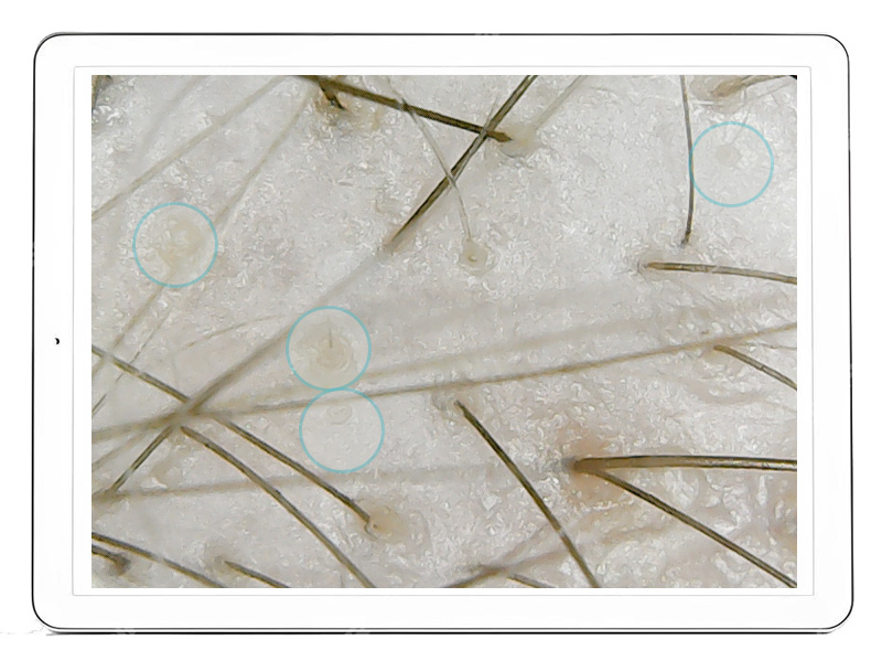 Hair Medica AI - Stan utraty włosów