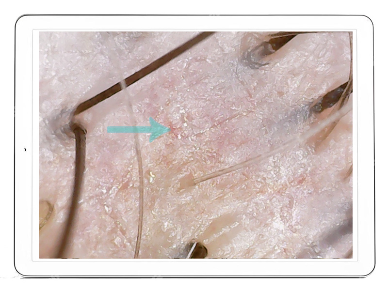 Hair Medica AI - Widok naczynek skóry głowy